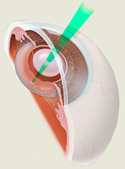 yag surgery